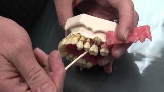 What is Periodontal Disease [upl. by Airalav]