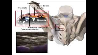 ULTRASOUND SACROILIAC JOINT INFILTRATION [upl. by Lraed]