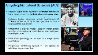 Amyotrophic Lateral Sclerosis ALS  Basics amp Clinical Presentation [upl. by Hevak]