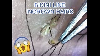 Satisfying Bikini Line Ingrown Hairs Microscopic [upl. by Eednas22]