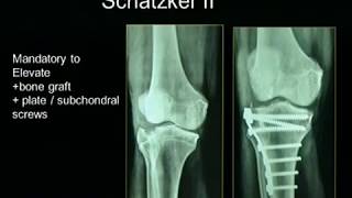 Tibial Plateau Fractures [upl. by Ignacius242]