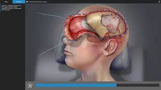 Traumatic Brain Injury  Brain Surgery Animation [upl. by Christan]