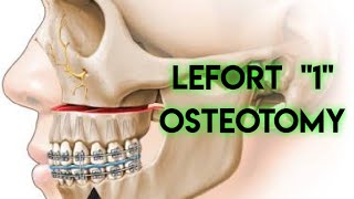 LEFORT 1  OSTEOTOMY  ORTHOGNATHIC SURGERY [upl. by Anihpesoj570]