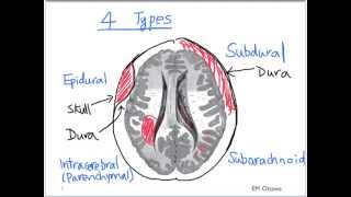 Intracranial Bleed  Part 1 [upl. by Relyc]