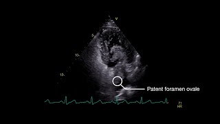 Stroke From Paradoxical Embolism Through a Patent Foramen Ovale [upl. by Noremmac]