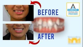 Invisalign Before and After Crowded Teeth [upl. by Nosnorb]