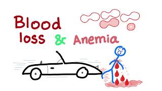 Blood Loss and Anemia  Hypovolemic shock  hemorrhagic shock  Causes of anemia [upl. by Atarman]