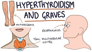 Understanding Hyperthyroidism and Graves Disease [upl. by Onibas573]