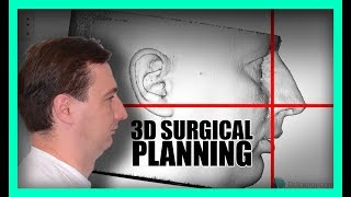 3D Virtual Surgical Planning ORTHOGNATHIC [upl. by Oralla]