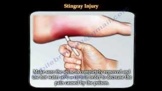 Stingray fish injury  Everything You Need To Know  Dr Nabil Ebraheim [upl. by Biddie]