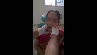 Jaw Joint Dislocation Slip  Manual Reduction Self  at Home Treatment DIY [upl. by Atirhs902]