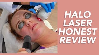 My Halo Laser Experience Honest Review Recovery and Before amp Afters [upl. by Ephraim]