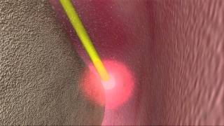 Laser Periodontal Therapy  WPT™ Animation [upl. by Elyl]