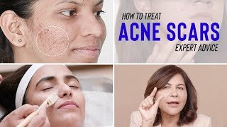 Treatments for ACNE SCARS  Dr Bindus Expert Advice [upl. by Scrope]