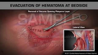 Evacuation of Hematoma at Bedside [upl. by Mhoj550]