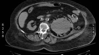 Subcapsular Hematoma CT Axial JETem 2018 [upl. by Leirda]