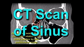 How To Read CT Sinus Scans Like An Expert [upl. by Linc]