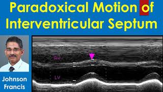 Paradoxical Motion of Interventricular Septum [upl. by Noit]