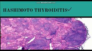 HASHIMOTOS Thyroiditis 5 Things YOU Need to Know 2024 [upl. by Alecram]