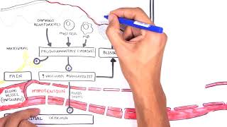 Burns DETAILED Overview  Types Pathophysiology TBSA [upl. by Allimaj]