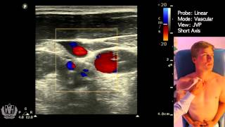 JVP Jugular Venous Pulsation Evaluation using Ultrasound [upl. by Nawyt]