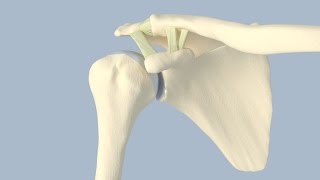 Acromioclavicular Separation Surgery [upl. by Saxet]