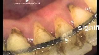 Non Surgical Periodontal Treatment [upl. by Joyce865]