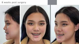 What to expect from corrective jaw surgery experience [upl. by Hasan]