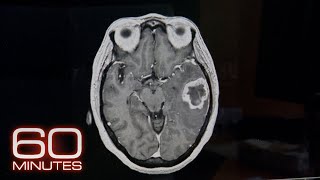 Frontotemporal Dementia  60 Minutes Archive [upl. by Ecnerol]