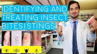 Insect Bites and Stings  Insect Bites Treatment  How to Treat Insect Bites and Stings  2018 [upl. by Prosperus]